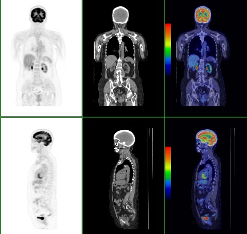 A PET scan uses a small amount of a radioactive drug to show differences between healthy and diseased tissue.